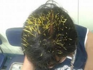Ouriço cai na cabeça de mulher que fica com mais de 270 espinhos cravados no couro cabeludo Ouriço cai na cabeça de mulher que fica com mais de 270 espinhos cravados no couro cabeludo